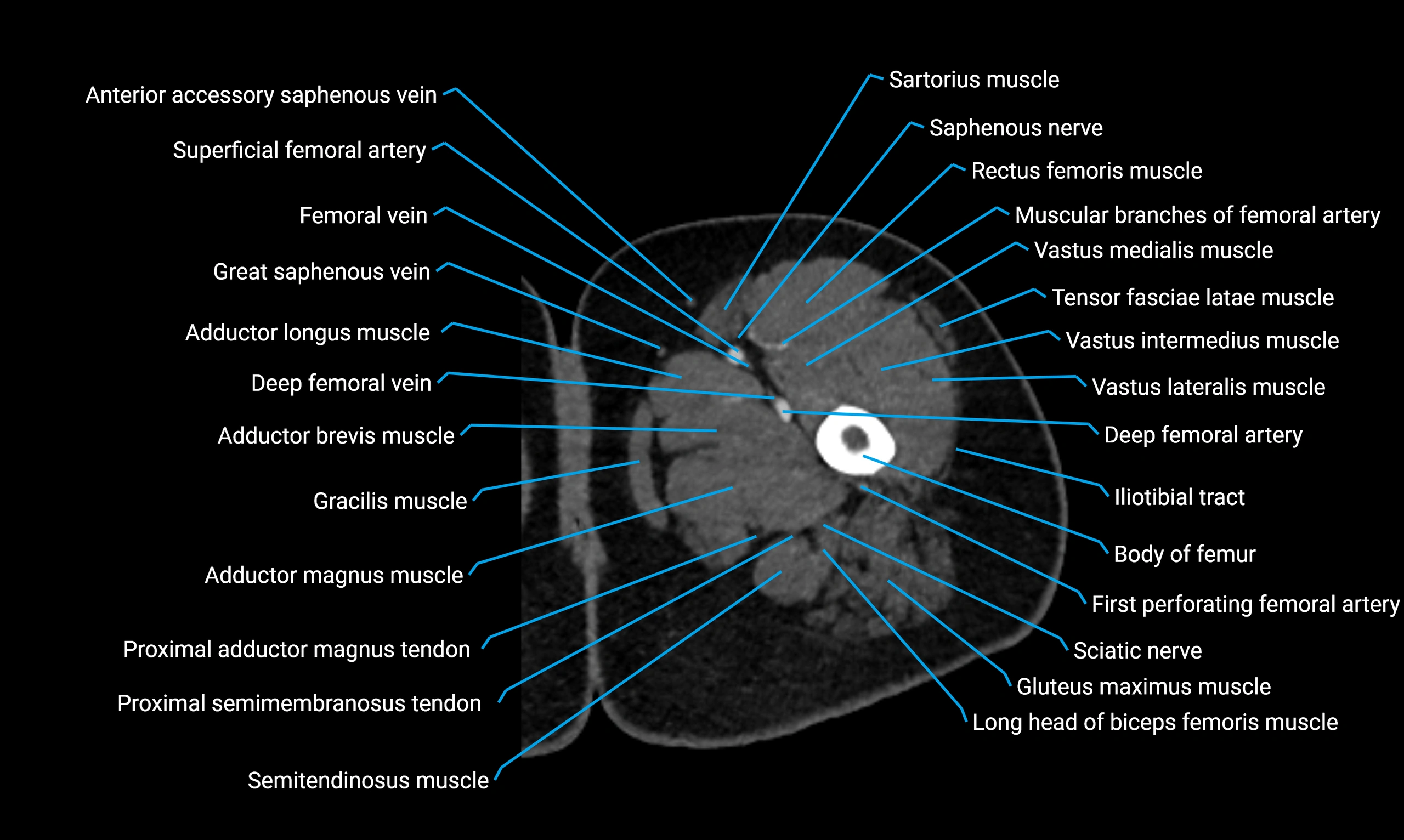 CT thigh axial cross sectional anatomy labelled image_27 (3).webp